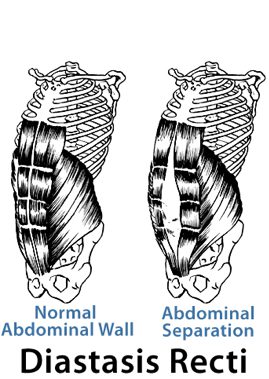 diastasis recti tummy mummy