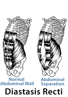 diastasis recti tummy mummy