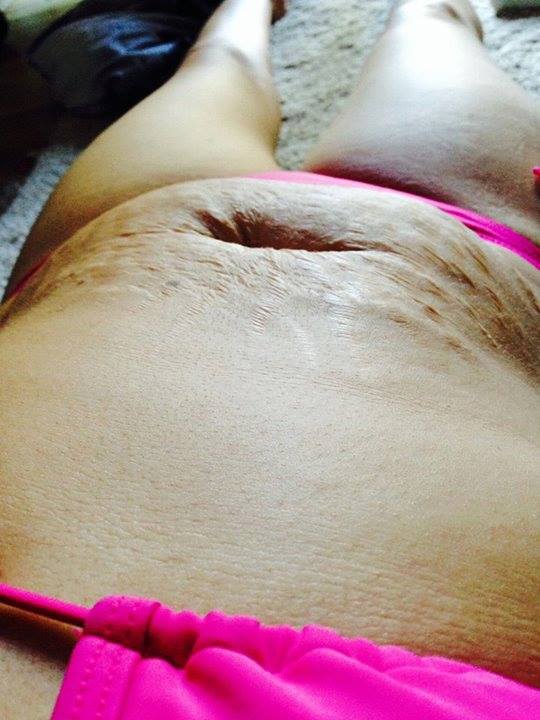 tannis post baby belly stretch marks body image