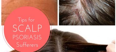 Tips for Scalp Psoriasis