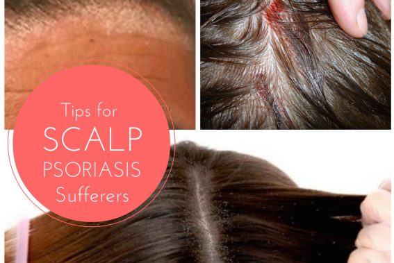 Tips for Scalp Psoriasis