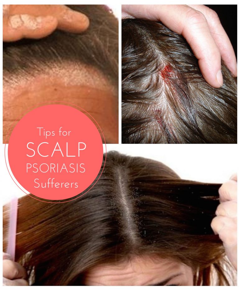 Tips for Scalp Psoriasis