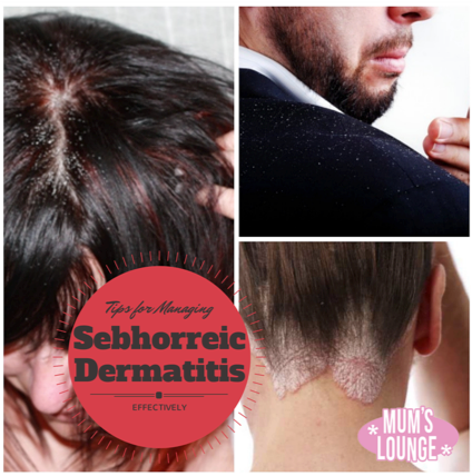 seborrhoeic dermatitis