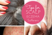 Scalp Eczema