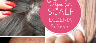 Scalp Eczema