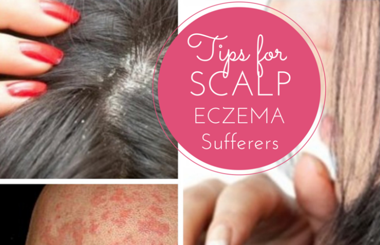 Scalp Eczema