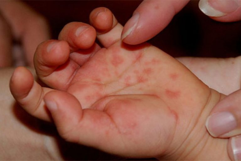 "Massive Outbreak" of Hand, Foot and Mouth Disease in