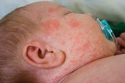 measles