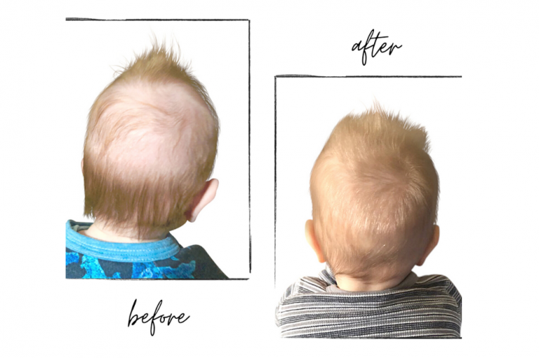 Hair Loss in Babies When to Worry
